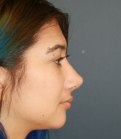 Feel Beautiful - Rhinoplasty 218 - After Photo